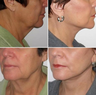 ABGD Αντιγραφή