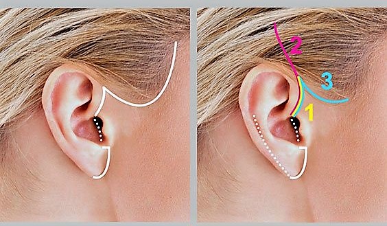 female facelift incisions 